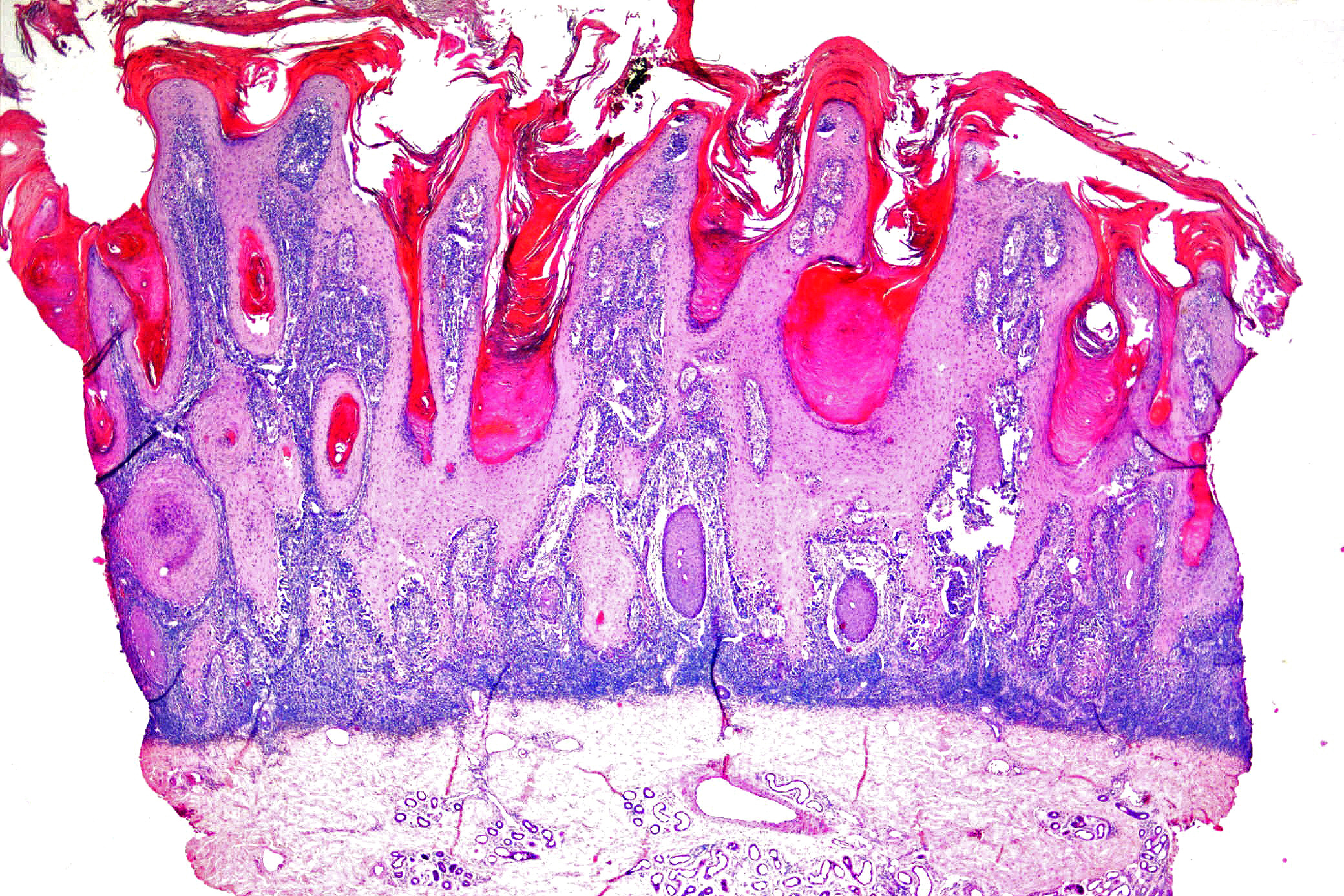 Pagetoid Reticulosis KiKo XP